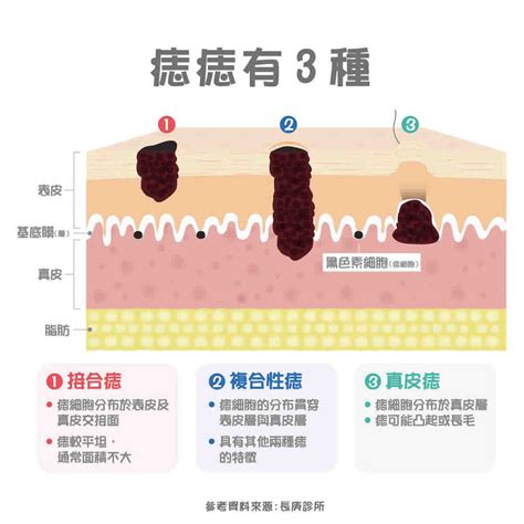 長毛的痣|痣變大、痣多或長毛會變皮膚癌？認識痣的形成與原因